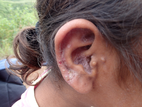 乾燥した膿がついた耳の少女