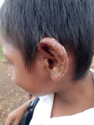 耳が炎症を起こしている子供