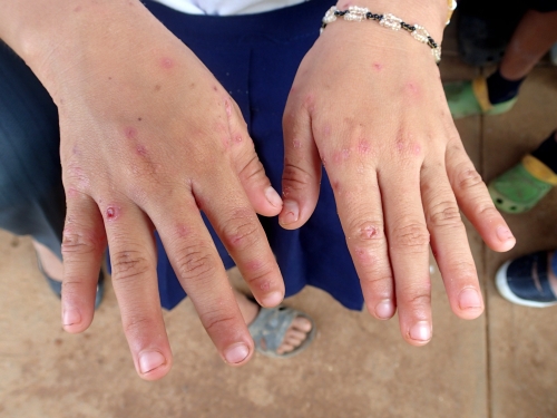 人間の皮膚に住むダニ疥癬（かいせん）に寄生された子供、頭皮がボロボロの皮膚病の子どもと途上国で出会った